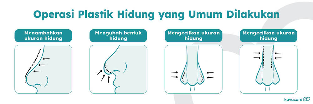 infografis operasi plastik hidung kavacare, rhinoplasty, operasi pembesaran hidung, operasi mengecilkan hidung, operasi hidung, kavacare, medical assistance, berobat ke luar negeri