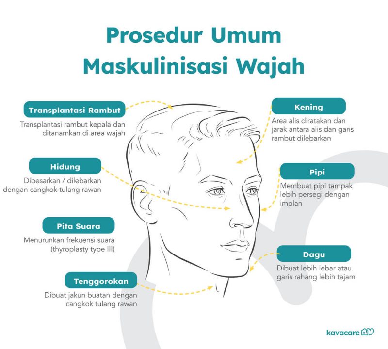 Infografis Prosedur Maskulinisasi Wajah Kavacare, Kavacare Facial Masculinization Procedure Infographic