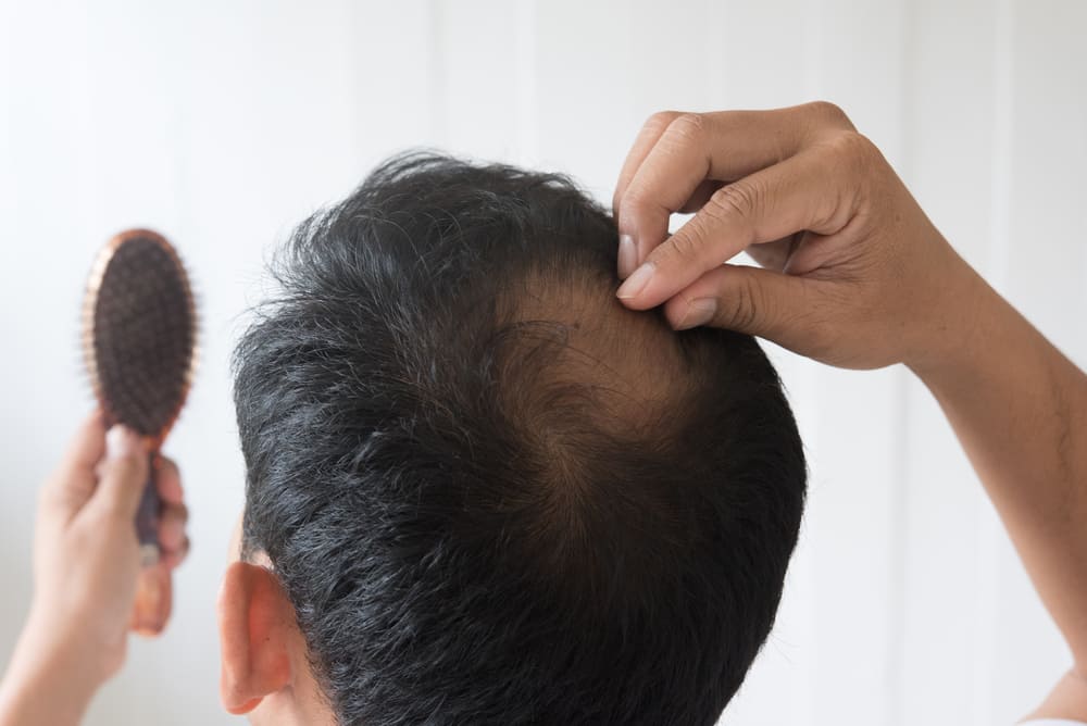 Alopecia Areata (Rambut Rontok): Gejala, Penyebab, dan Cara Menangani